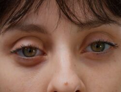 Apa Itu Ptosis, Kondisi Mata yang Disebut Pandji di Mens Rea