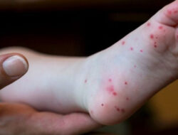 Superflu Terdeteksi Sejak Agustus, 62 Kasus Dilaporkan di Indonesia