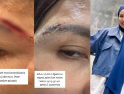 Tya Ariestya Alami Kecelakaan Saat Ramadan, Jidat Robek dan Butuh 8 Jahitan