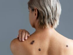 Kanker Kulit Stadium 4: Penyebaran ke Organ yang Mengancam