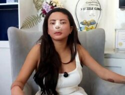 Untuk Tetap Terkenal, Seleb Pasang Tulang Iga di Hidung, Habiskan Rp100 Juta